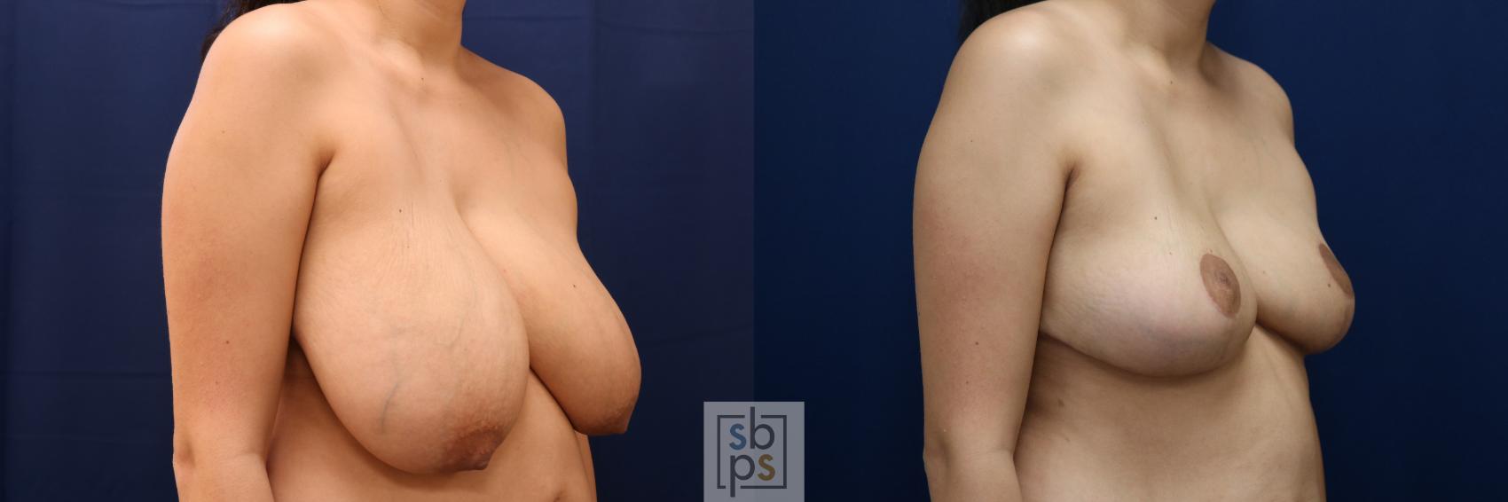 Before & After Breast Reduction Case 694 Right Oblique View in Torrance & Los Angeles, CA, CA