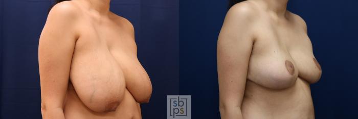 Before & After Breast Reduction Case 694 Right Oblique View in Los Angeles & Torrance, CA, CA