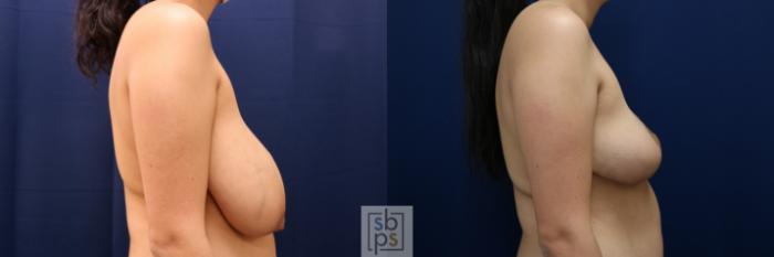 Before & After Breast Reduction Case 694 Right Side View in Los Angeles & Torrance, CA, CA