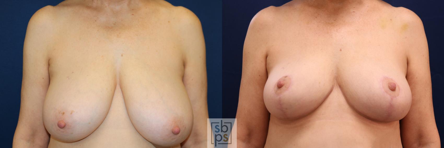 Before & After Breast Reduction Case 718 Front View in Los Angeles & Torrance, CA, CA