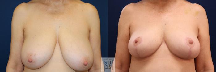 Before & After Breast Reduction Case 718 Front View in Los Angeles & Torrance, CA, CA