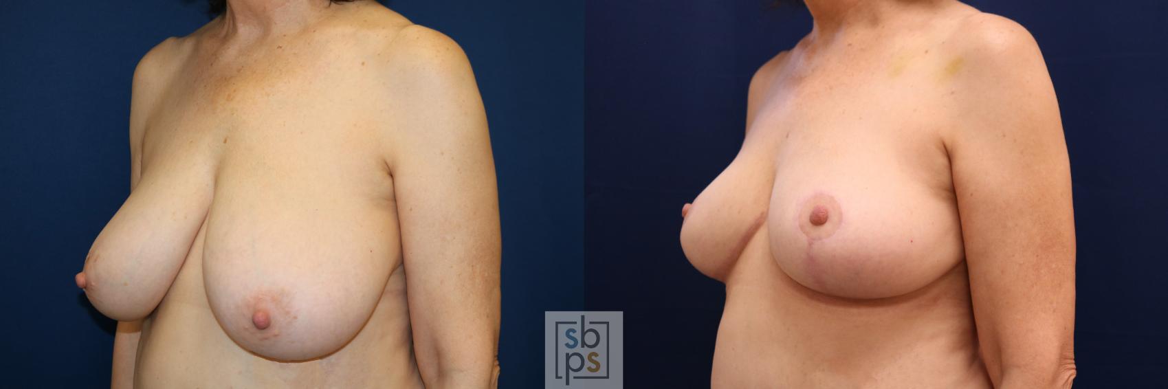 Before & After Breast Reduction Case 718 Left Oblique View in Torrance & Los Angeles, CA, CA
