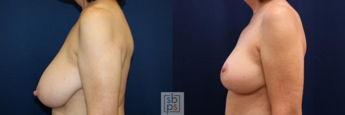 Before & After Breast Reduction Case 718 Left Side View in Los Angeles & Torrance, CA, CA