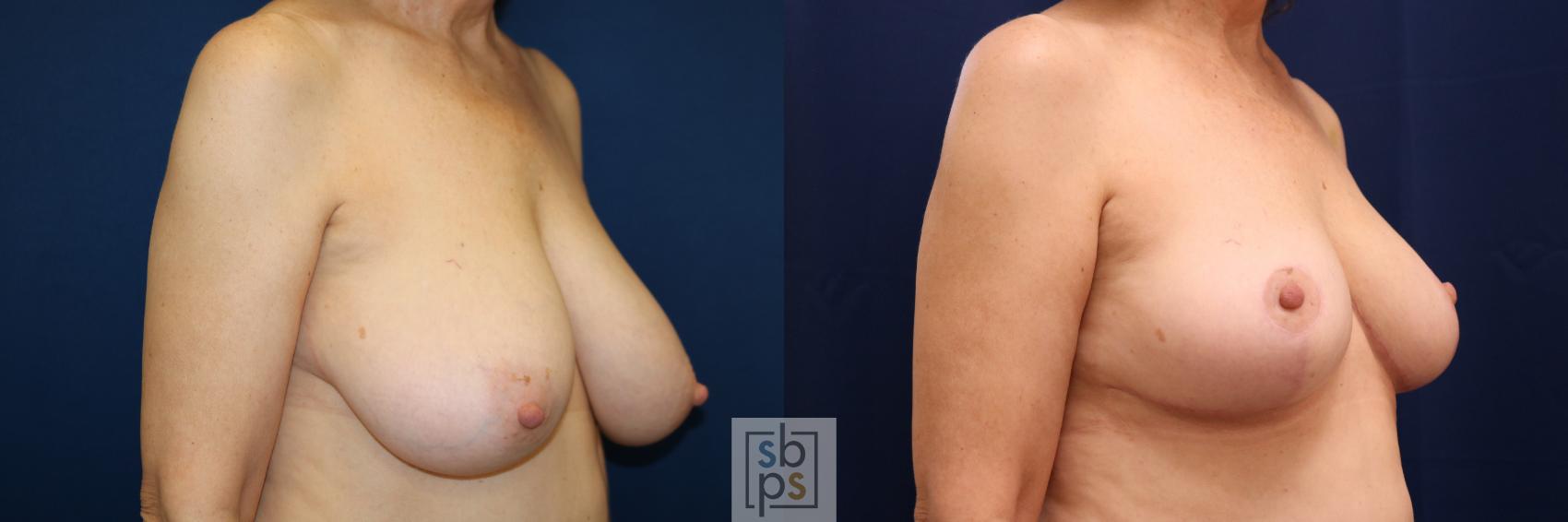 Before & After Breast Reduction Case 718 Right Oblique View in Torrance & Los Angeles, CA, CA