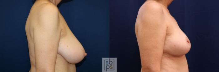 Before & After Breast Reduction Case 718 Right Side View in Los Angeles & Torrance, CA, CA