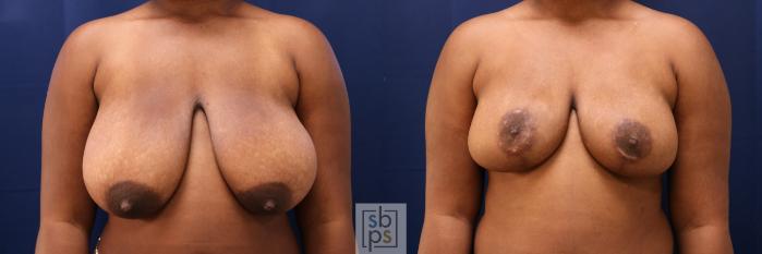 Before & After Breast Reduction Case 730 Front View in Los Angeles & Torrance, CA, CA