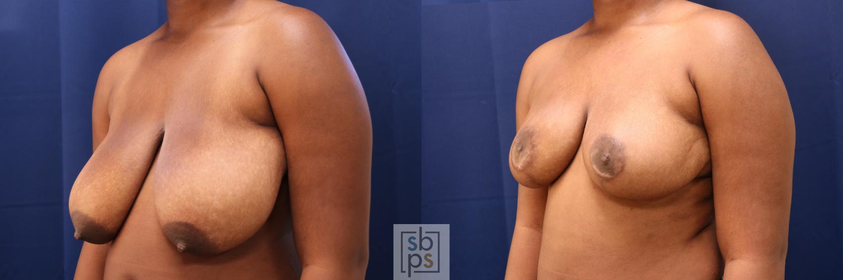 Before & After Breast Reduction Case 730 Left Oblique View in Torrance & Los Angeles, CA, CA