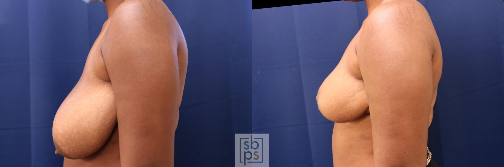 Before & After Breast Reduction Case 730 Left Side View in Torrance & Los Angeles, CA, CA