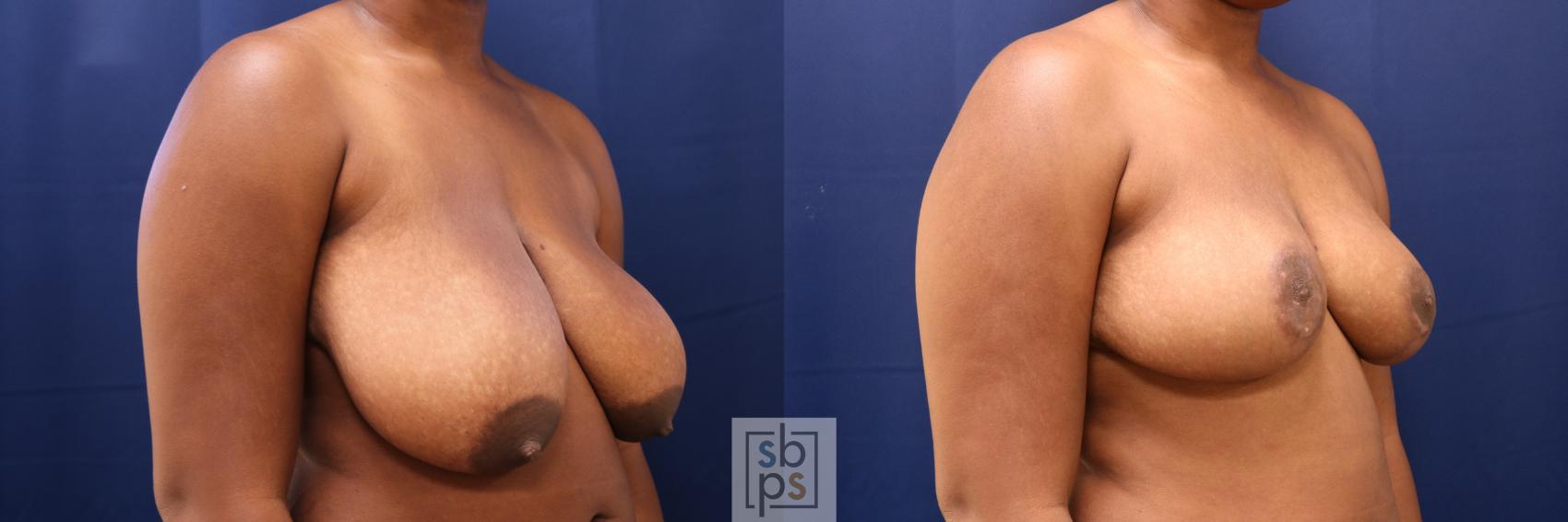 Before & After Breast Reduction Case 730 Right Oblique View in Torrance & Los Angeles, CA, CA