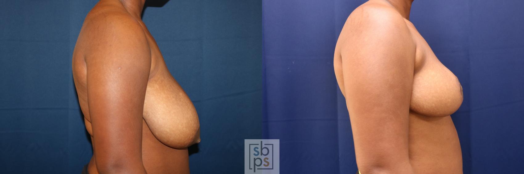 Before & After Breast Reduction Case 730 Right Side View in Torrance & Los Angeles, CA, CA