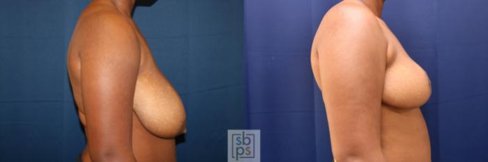 Before & After Breast Reduction Case 730 Right Side View in Los Angeles & Torrance, CA, CA