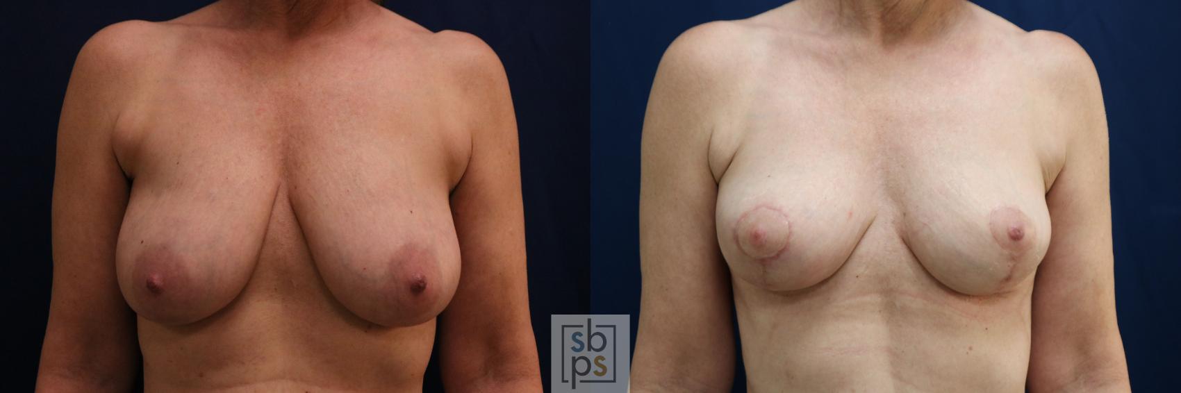Before & After Breast Reduction Case 752 Front View in Los Angeles, Torrance & Long Beach, CA