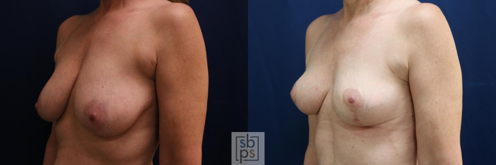 Before & After Breast Reduction Case 752 Left Oblique View in Los Angeles, Torrance & Long Beach, CA