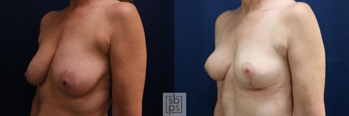 Before & After Breast Reduction Case 752 Left Oblique View in Los Angeles, Torrance & Long Beach, CA