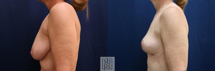 Before & After Breast Reduction Case 752 Left Side View in Los Angeles, Torrance & Long Beach, CA