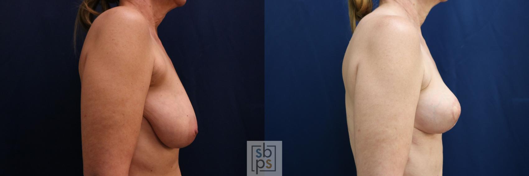 Before & After Breast Reduction Case 752 Right Side View in Los Angeles, Torrance & Long Beach, CA