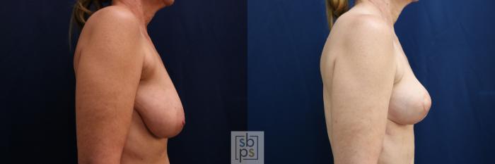 Before & After Breast Reduction Case 752 Right Side View in Los Angeles, Torrance & Long Beach, CA