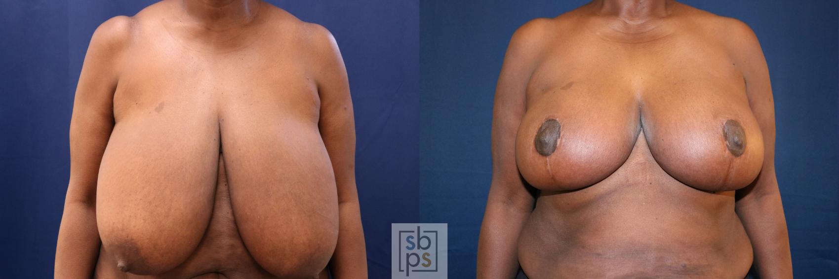 Before & After Breast Reduction Case 759 Front View in Los Angeles, Torrance & Long Beach, CA