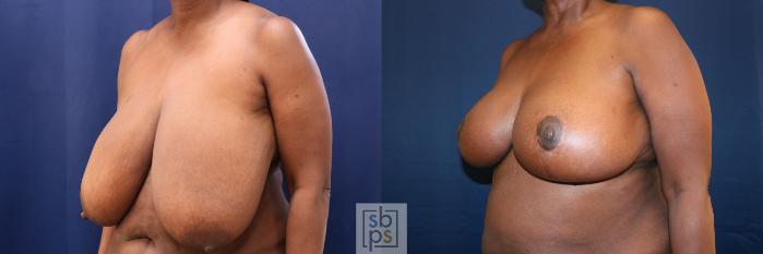 Before & After Breast Reduction Case 759 Left Oblique View in Los Angeles, Torrance & Long Beach, CA