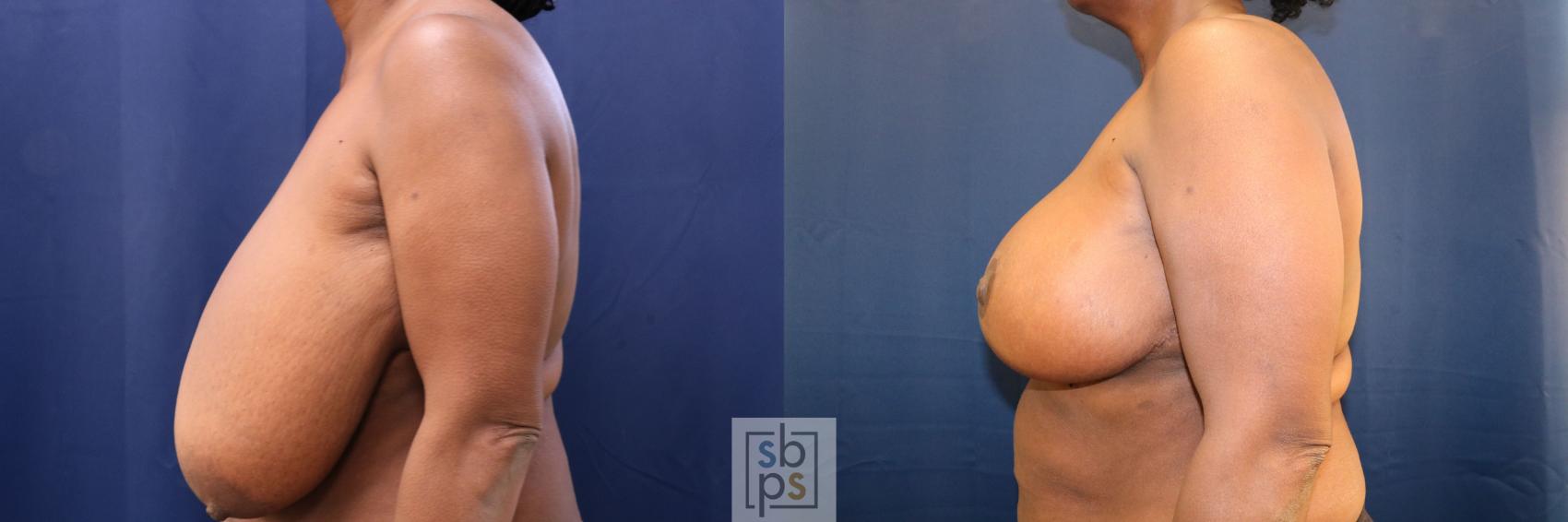 Before & After Breast Reduction Case 759 Left Side View in Los Angeles, Torrance & Long Beach, CA