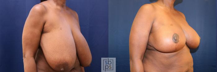 Before & After Breast Reduction Case 759 Right Oblique View in Los Angeles, Torrance & Long Beach, CA