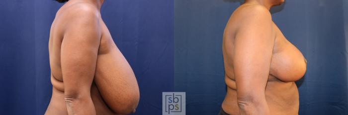 Before & After Breast Reduction Case 759 Right Side View in Los Angeles, Torrance & Long Beach, CA