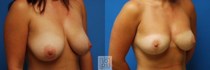 Before & After Breast Reduction Case 76 View #2 View in Torrance, CA