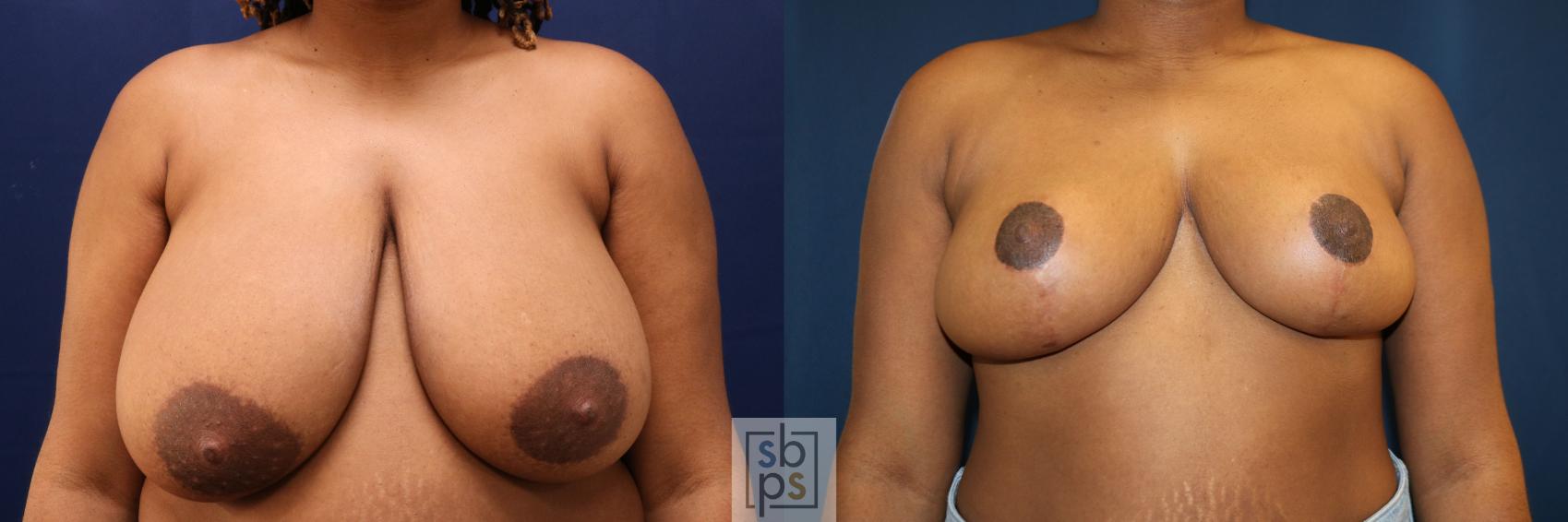 Before & After Breast Reduction Case 761 Front View in Los Angeles, Torrance & Long Beach, CA