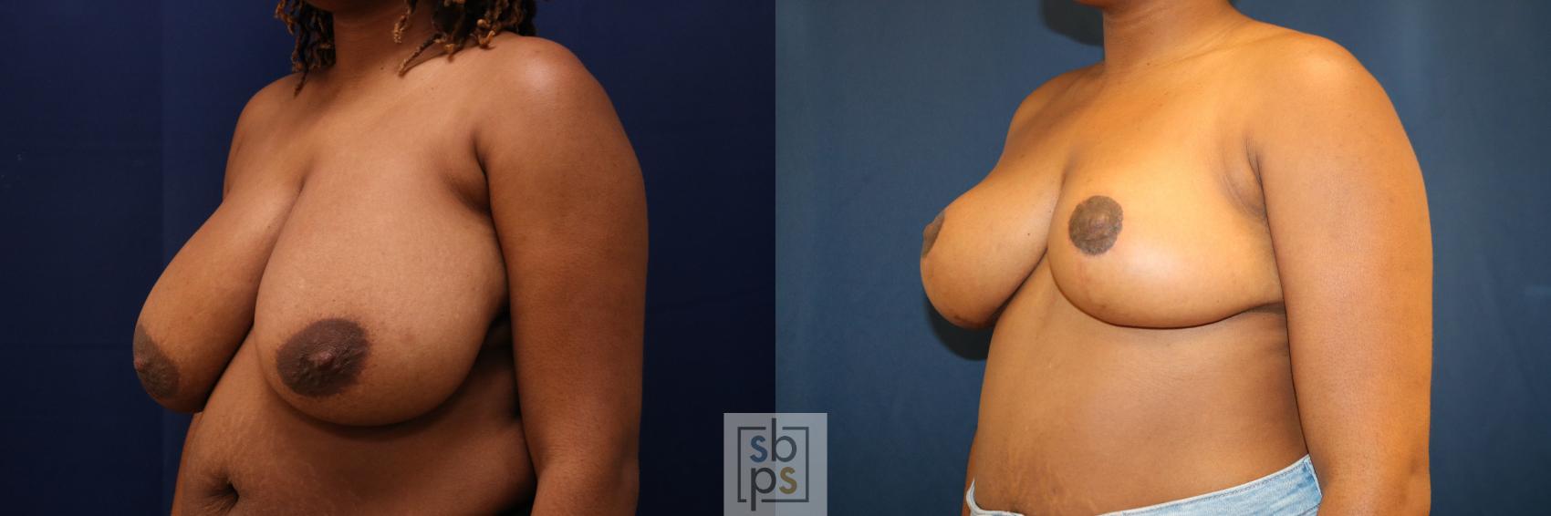 Before & After Breast Reduction Case 761 Left Oblique View in Los Angeles, Torrance & Long Beach, CA