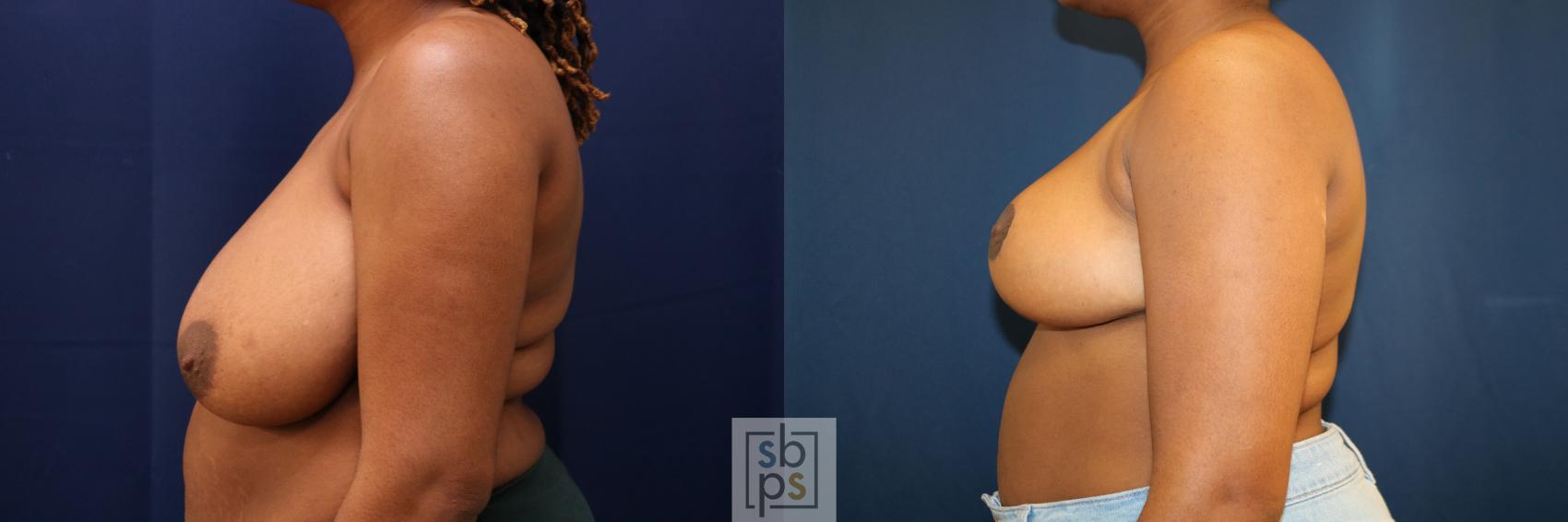 Before & After Breast Reduction Case 761 Left Side View in Los Angeles, Torrance & Long Beach, CA