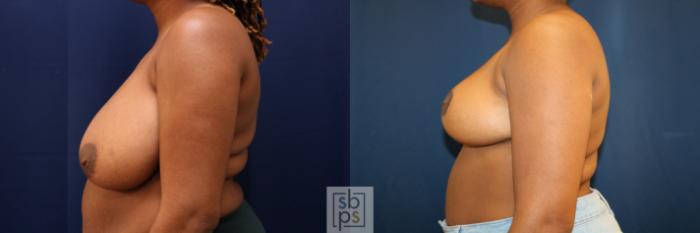 Before & After Breast Reduction Case 761 Left Side View in Los Angeles, Torrance & Long Beach, CA