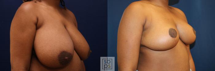 Before & After Breast Reduction Case 761 Right Oblique View in Los Angeles, Torrance & Long Beach, CA