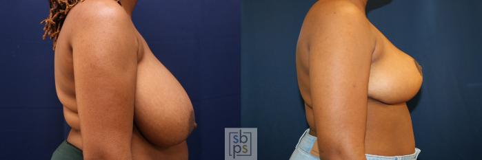 Before & After Breast Reduction Case 761 Right Side View in Los Angeles, Torrance & Long Beach, CA