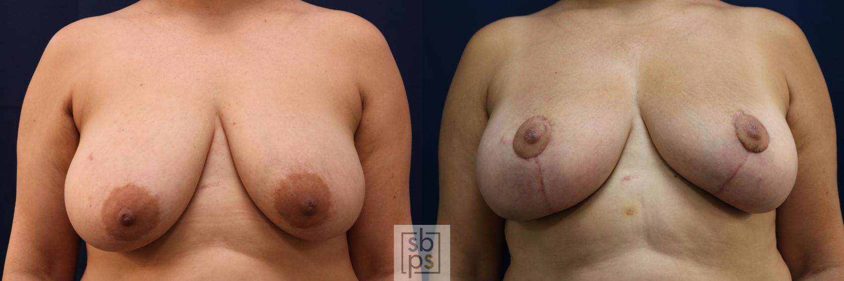 Before & After Breast Reduction Case 762 Front View in Los Angeles, Torrance & Long Beach, CA