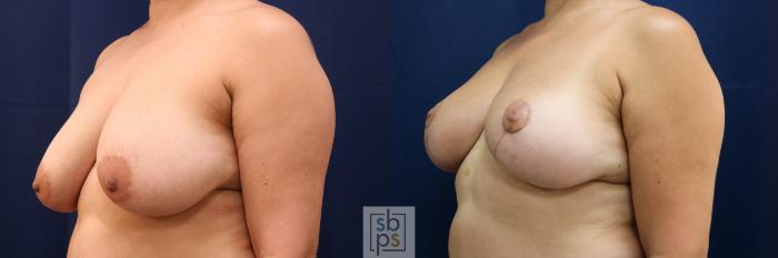 Before & After Breast Reduction Case 762 Left Oblique View in Los Angeles, Torrance & Long Beach, CA