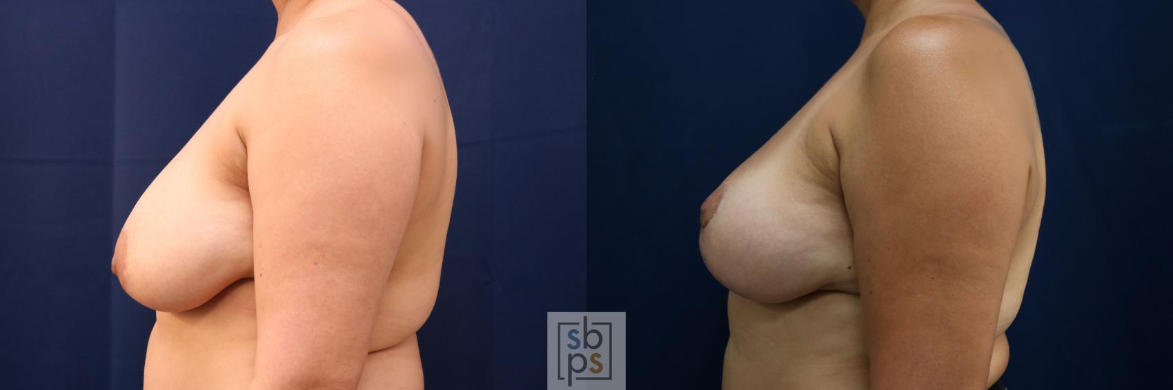 Before & After Breast Reduction Case 762 Left Side View in Los Angeles, Torrance & Long Beach, CA