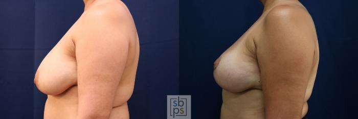 Before & After Breast Reduction Case 762 Left Side View in Los Angeles, Torrance & Long Beach, CA