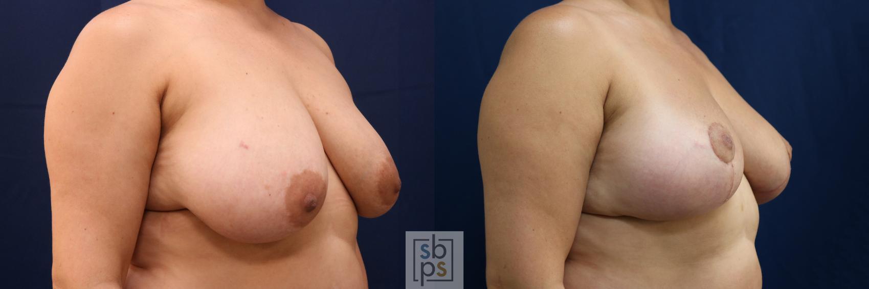 Before & After Breast Reduction Case 762 Right Oblique View in Los Angeles, Torrance & Long Beach, CA