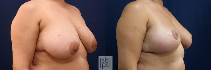 Before & After Breast Reduction Case 762 Right Oblique View in Los Angeles, Torrance & Long Beach, CA