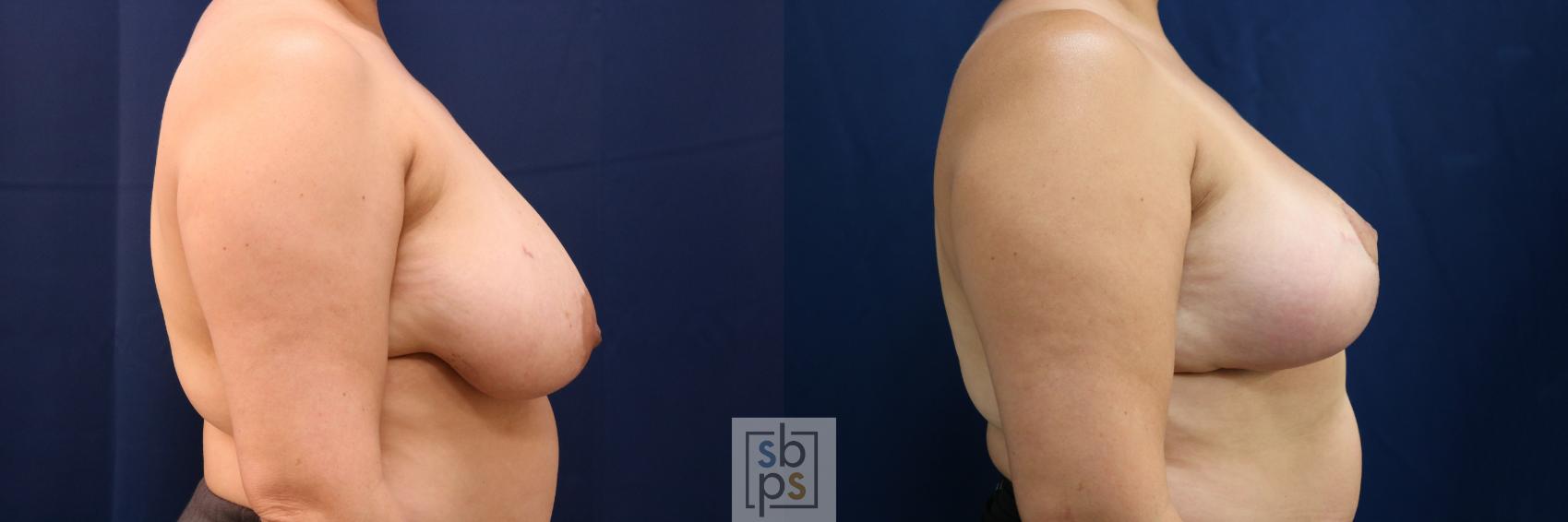 Before & After Breast Reduction Case 762 Right Side View in Los Angeles, Torrance & Long Beach, CA