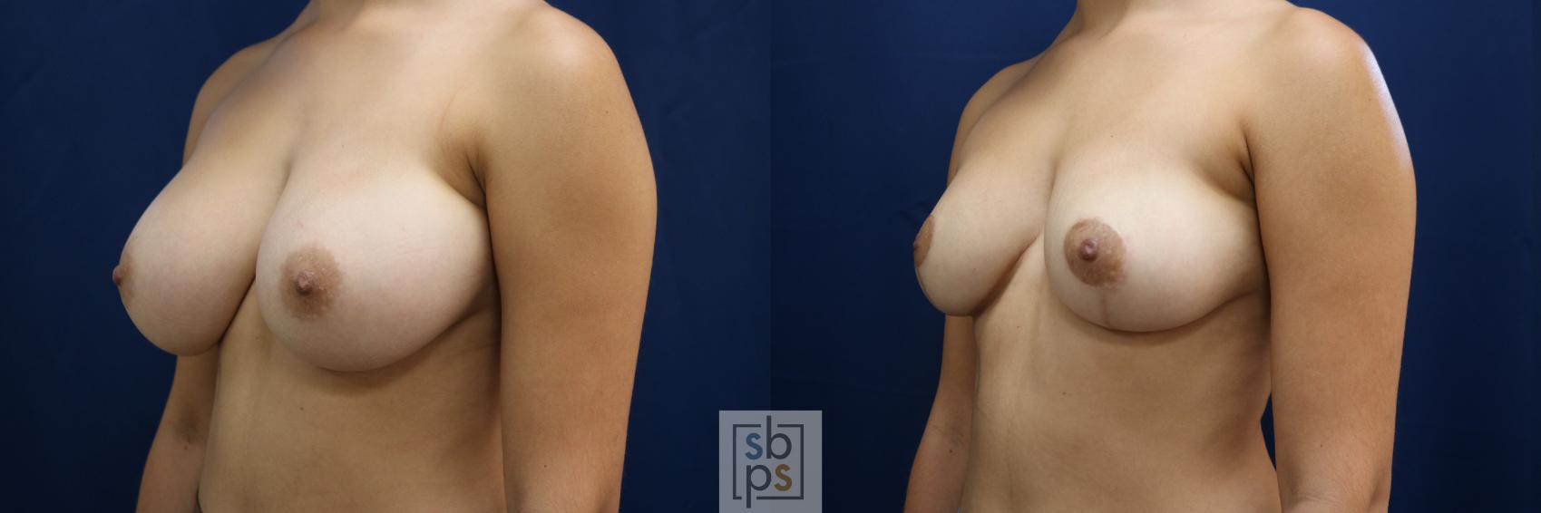 Before & After Breast Reduction Case 763 Left Oblique View in Los Angeles, Torrance & Long Beach, CA