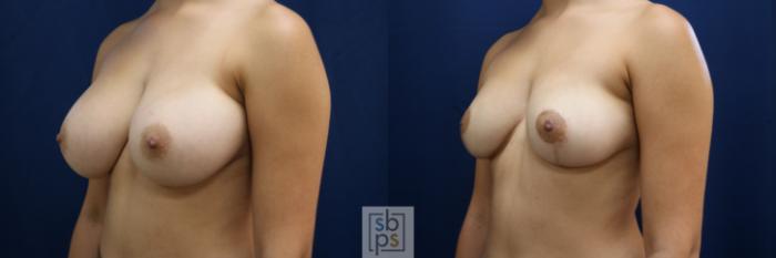 Before & After Breast Reduction Case 763 Left Oblique View in Los Angeles, Torrance & Long Beach, CA