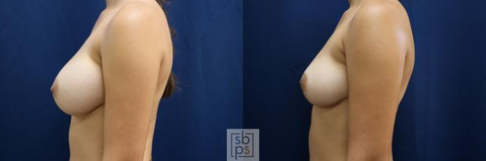 Before & After Breast Reduction Case 763 Left Side View in Los Angeles, Torrance & Long Beach, CA