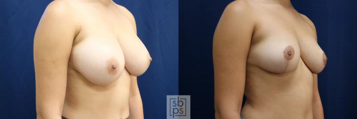 Before & After Breast Reduction Case 763 Right Oblique View in Los Angeles, Torrance & Long Beach, CA