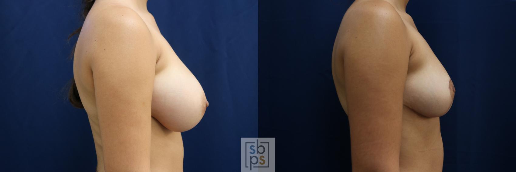 Before & After Breast Reduction Case 763 Right Side View in Los Angeles, Torrance & Long Beach, CA