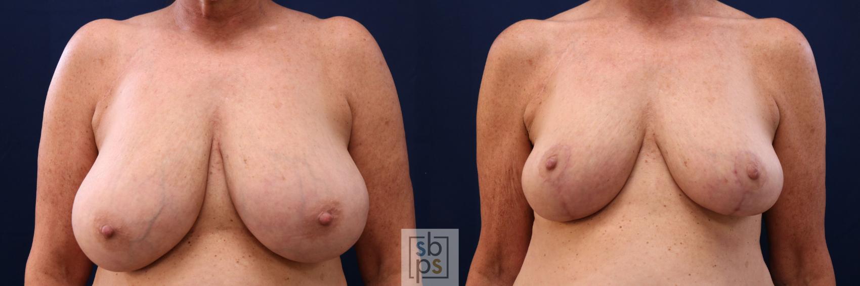 Before & After Breast Reduction Case 764 Front View in Los Angeles, Torrance & Long Beach, CA