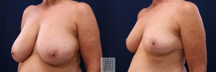 Before & After Breast Reduction Case 764 Left Oblique View in Los Angeles, Torrance & Long Beach, CA