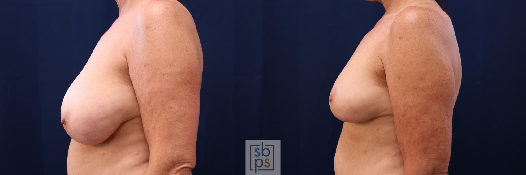Before & After Breast Reduction Case 764 Left Side View in Los Angeles, Torrance & Long Beach, CA