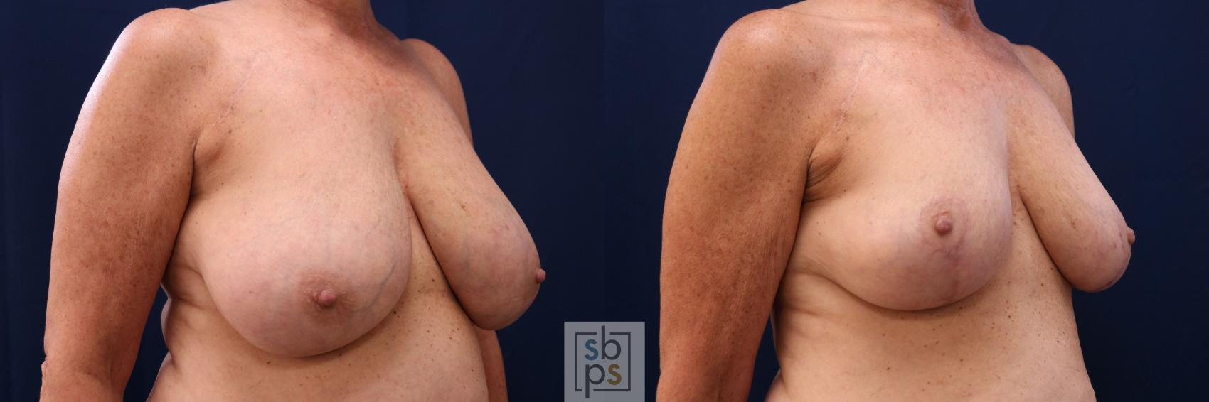 Before & After Breast Reduction Case 764 Right Oblique View in Los Angeles, Torrance & Long Beach, CA