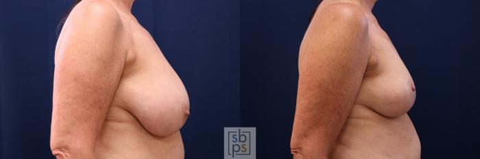 Before & After Breast Reduction Case 764 Right Side View in Los Angeles, Torrance & Long Beach, CA
